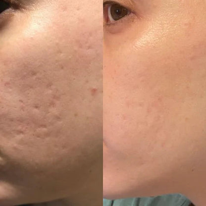 Onesiena™ Silicone Scar & Wrinkle Tape